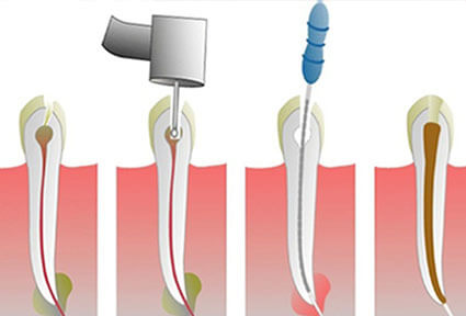 Illustration of a root canal procedure done in Costa Rica.