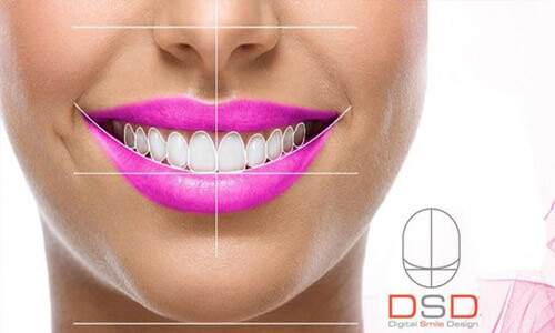 Close-up picture of a smiling young woman happy with her Digital Smile Design (DSD) at Premier Holistic Dental in Costa Rica.  She is wearing purple lipstick and showing perfect white teeth.