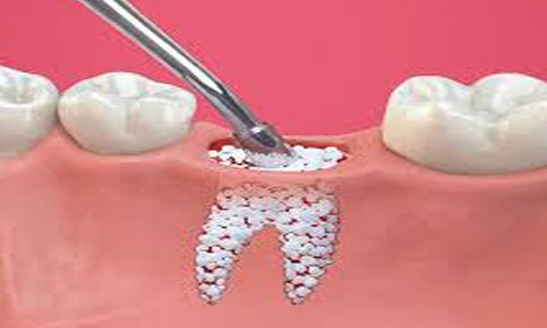 Illustration of a bone graft procedure.  The illustration shows the bone grafted tooth where the dental procedure will be done to support dental implants.