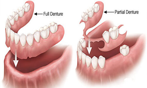 Illustration of a Holistic denture as made in San Jose, Costa Rica.  The illustration shows how a full denture or a partial denture fits into place in the mouth.