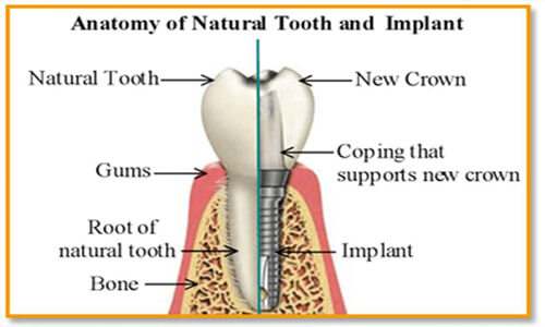 Illustration of a natural tooth and a dental implant.  The illustration shows a cross section of a tooth and root compared to a cross section of an implant with crown.