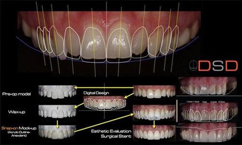 Illustration of a Digital Smile Design (DSD) computer screen showing a dental design.  The illustration shows several angles of teeth design.