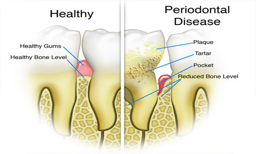 Illustration of a tooth with periodontal disease.  The illustration shows a healthy tooth and a diseased tooth for comparison.