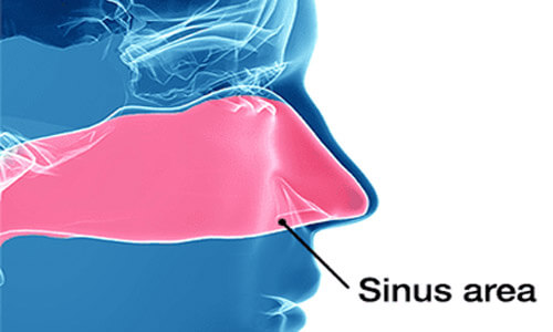 Illustration of a dental sinus lift procedure.  The illustration shows the sinus area above the upper teeth where the dental procedure will be done to support dental implants.
