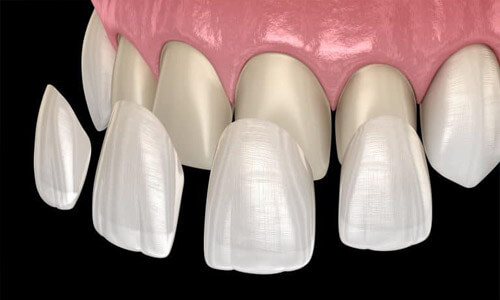 Illustration of a several dental veneers showing how they are placed over existing teeth. The teeth are white and the illustration shows the upper teeth.