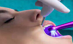 Picture of a woman patient showing an ozone therapy dental procedure by Premier Holistic Dental in London.