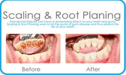 Illustration of a scaling and root planing denture being done in the lower jaw by Premier Holistic Dental in London.
