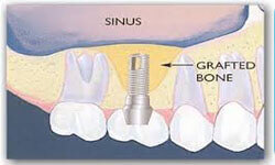 Illustration of a Sinus Lift being performed in the upper jaw by Premier Holistic Dental in London.