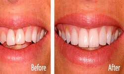 Picture of a smiling woman showing her dental veneers procedure by Premier Holistic Dental in London.